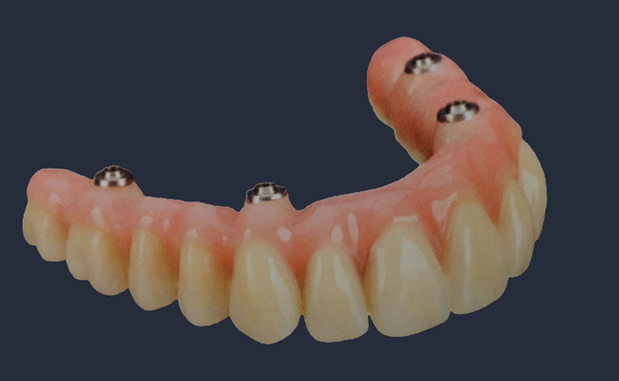 Gaumenplatte zahnersatz Zahnprothese Oberkiefer