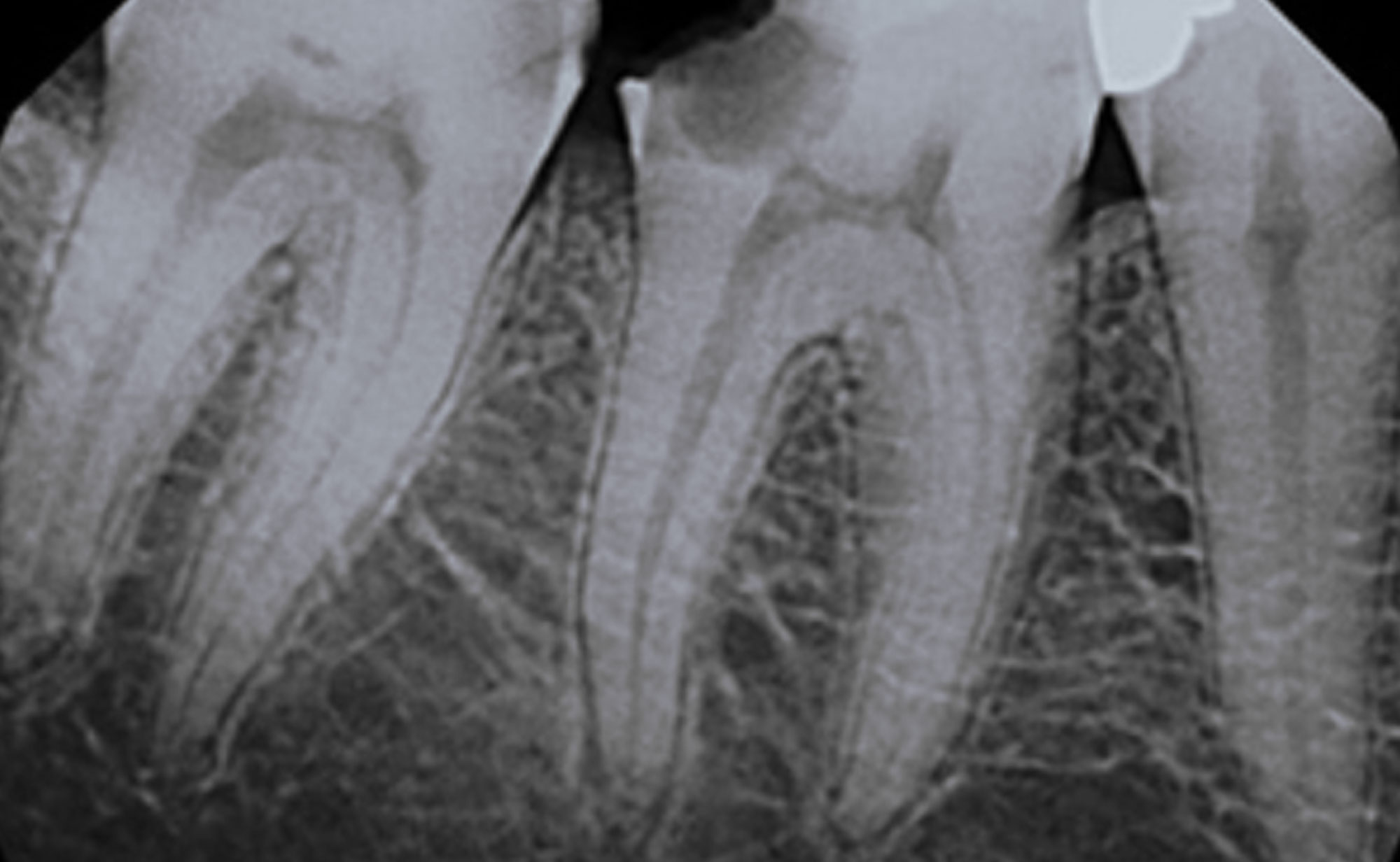 Wurzelkanal-Behandlung: Karies in Kammer des Zahnnerven