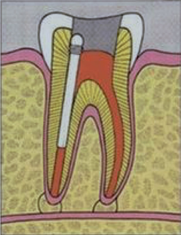 Wurzelkanal-Behandlung: Zahn durch Glasfaser- oder Metallstift stabilisiert 