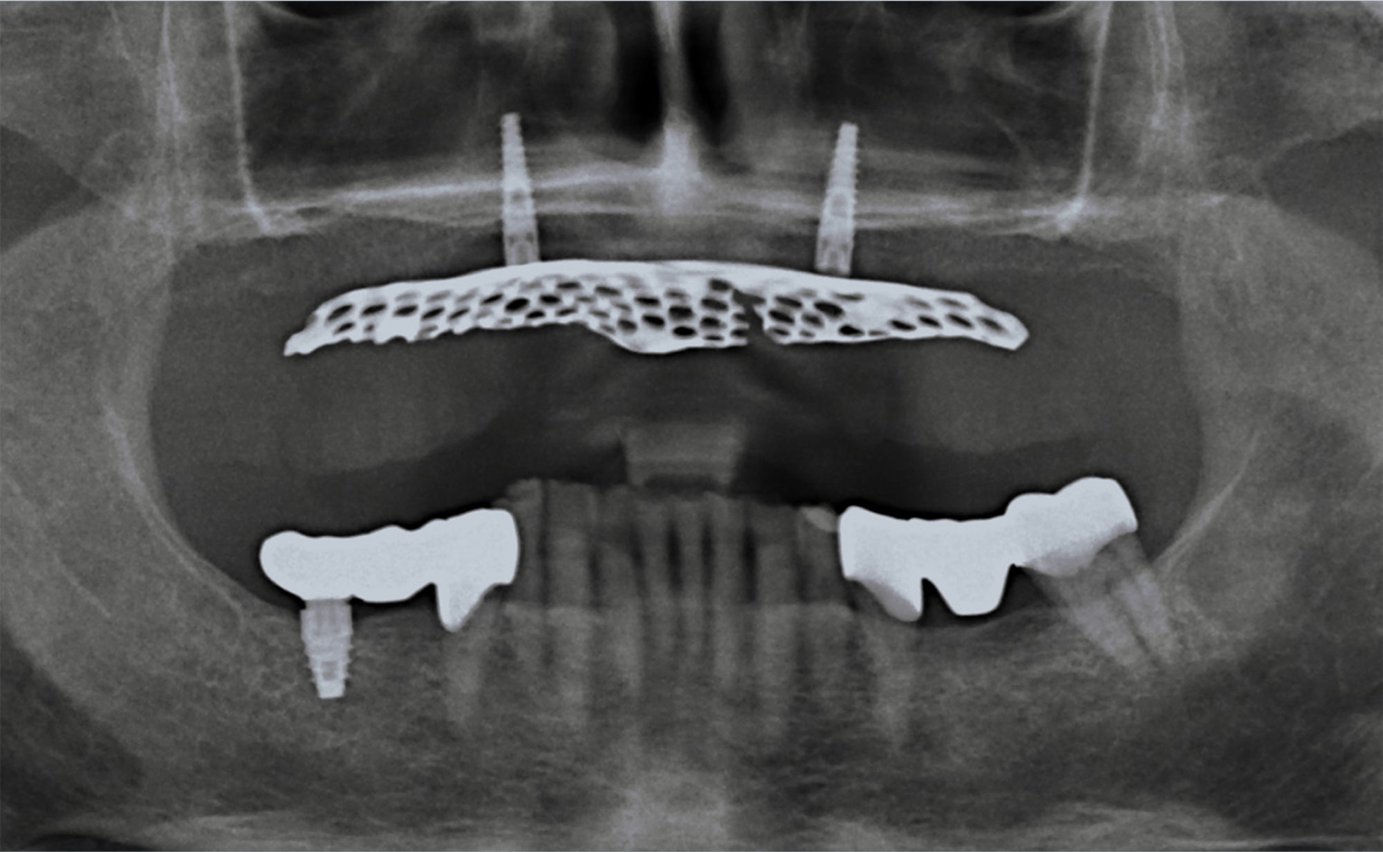 Zwei Implantate bei einem vollständig abgebauten Oberkiefer